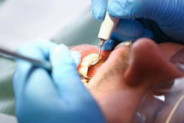 Best Emergency Dental Care for Sports Injuries in Macon, GA